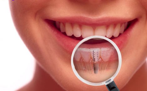 dental implants doncaster